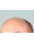 Before Hair Transplant&nbsp;2 Sessions (Areas)